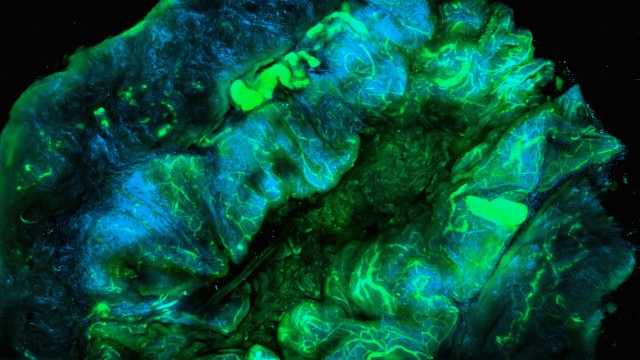 Image representing the publication, Association of functional, inherited vitamin D–binding protein variants with melanoma-specific death