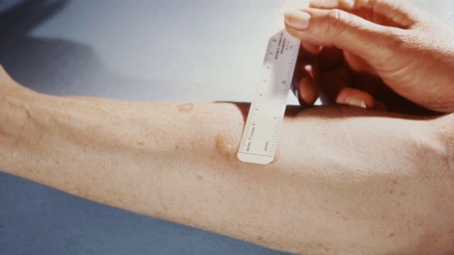 Melanoma Risk